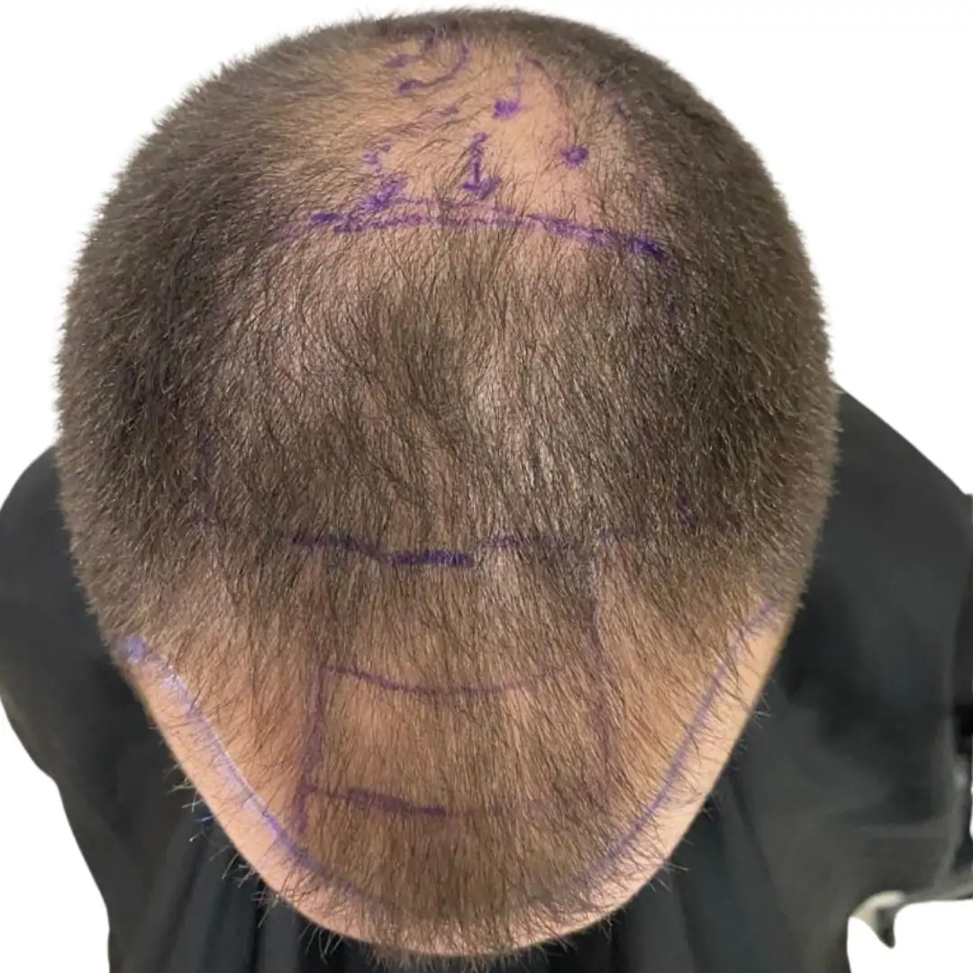 Paciente antes del injerto capilar con pérdida de densidad frontal y superior