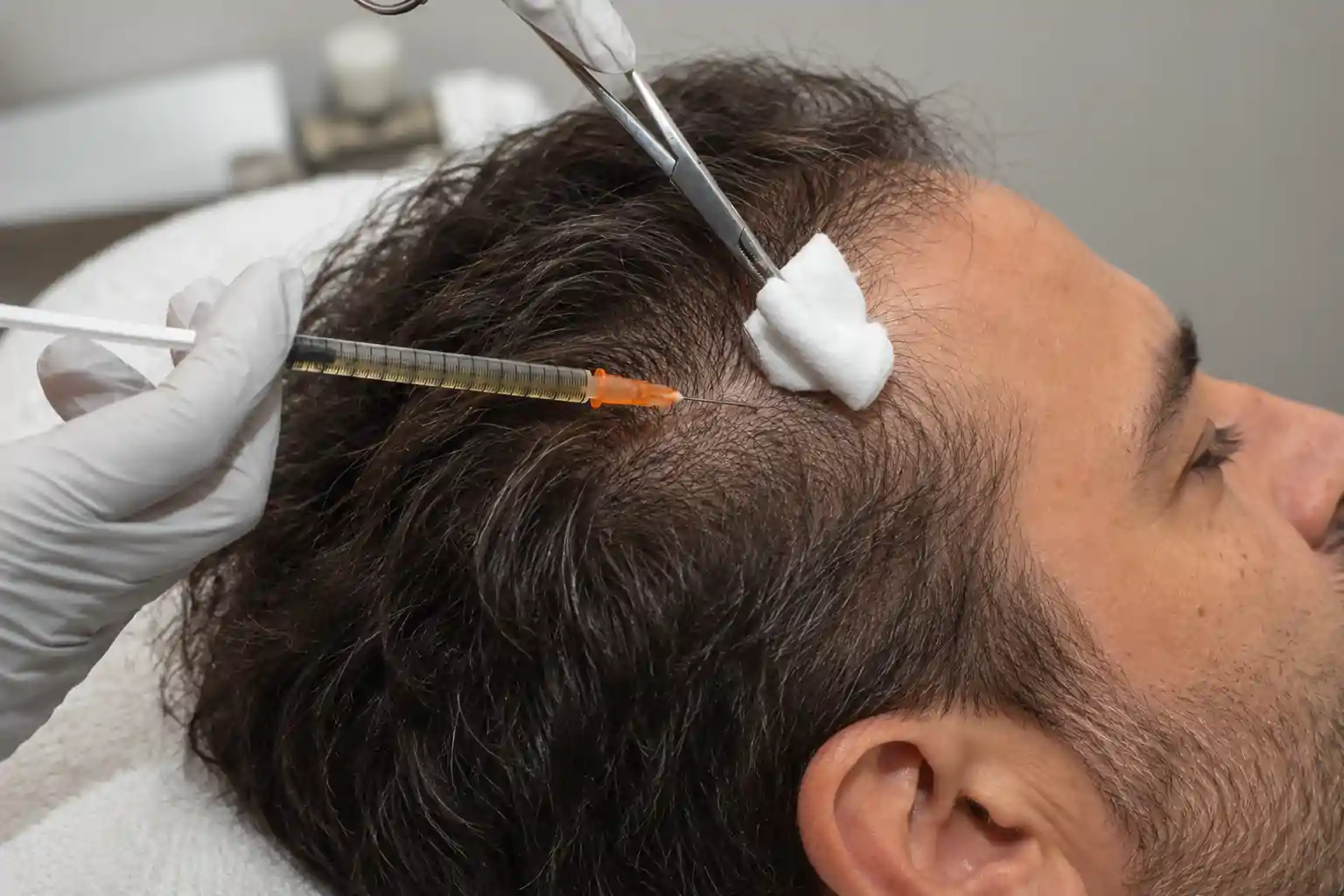 Aplicación de mesoterapia capilar en Alfa Clinics Zaragoza