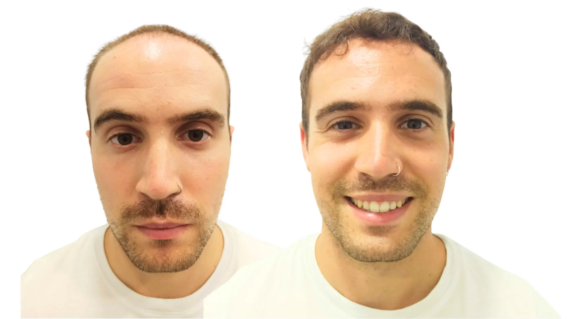 Resultado de injerto capilar antes y después en Alfa Clinics Zaragoza