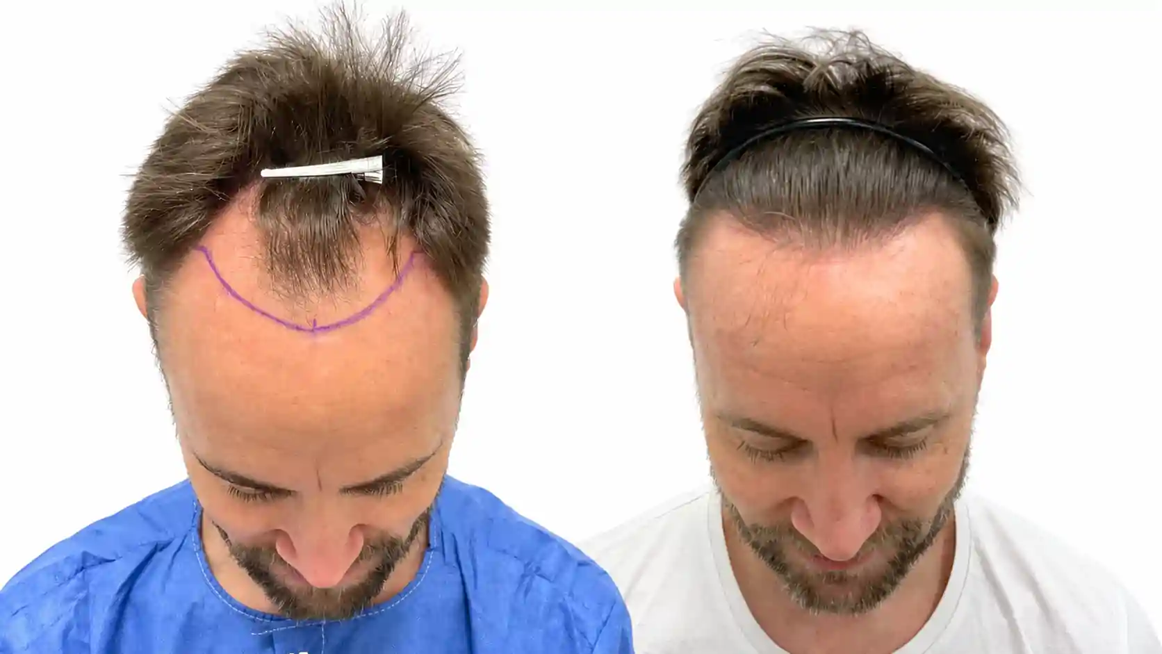 Evolución y resultados de un injerto capilar