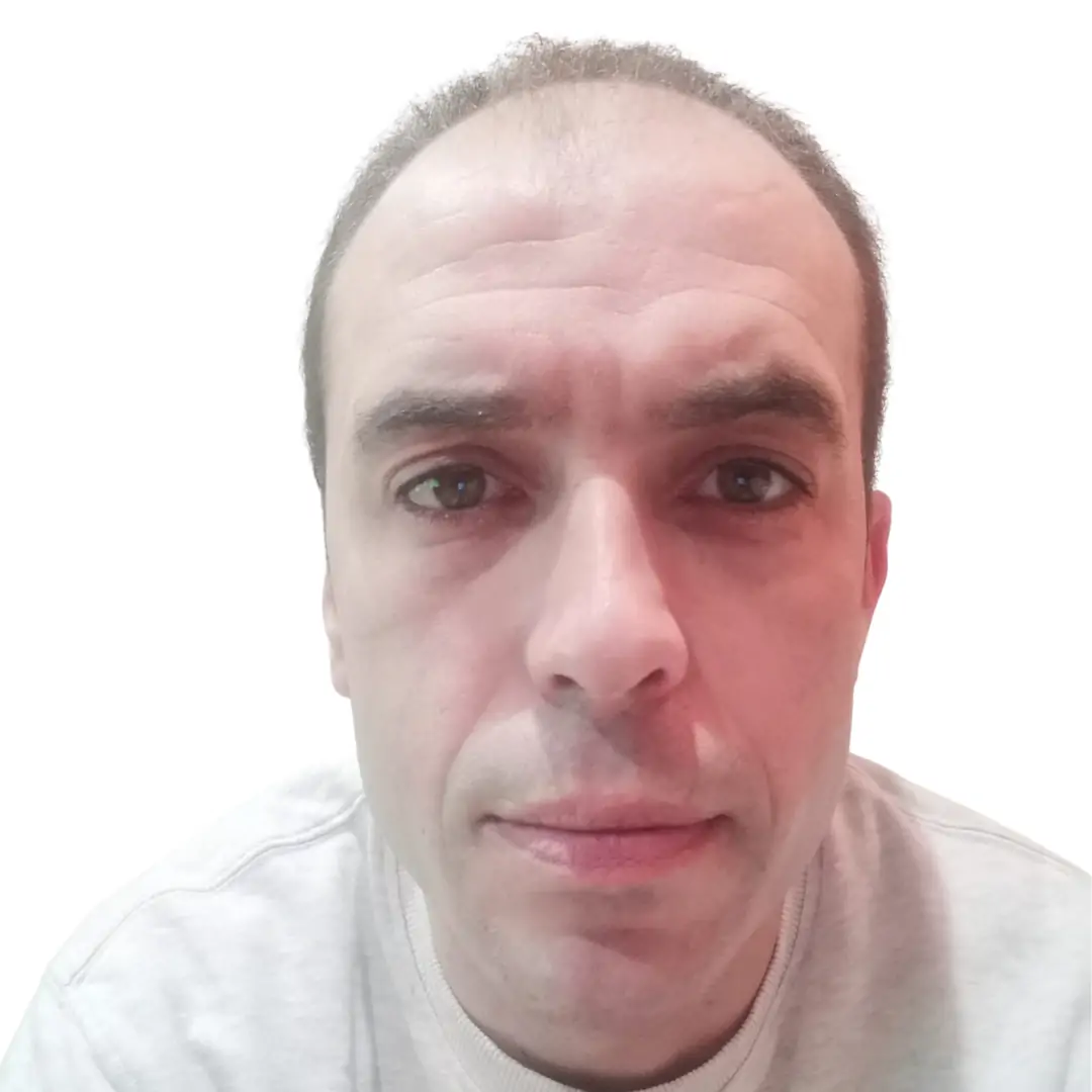Paciente antes del injerto capilar con entradas y retroceso de la línea frontal