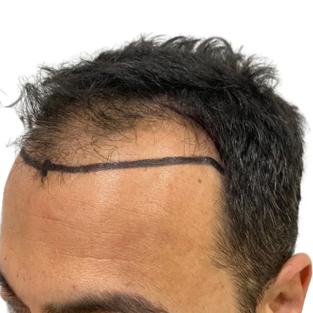 Paciente · entradas y línea frontal — antes