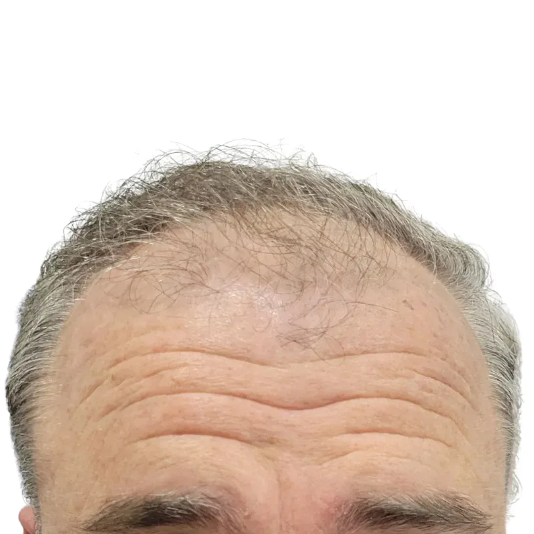Paciente · línea de implantación frontal — antes