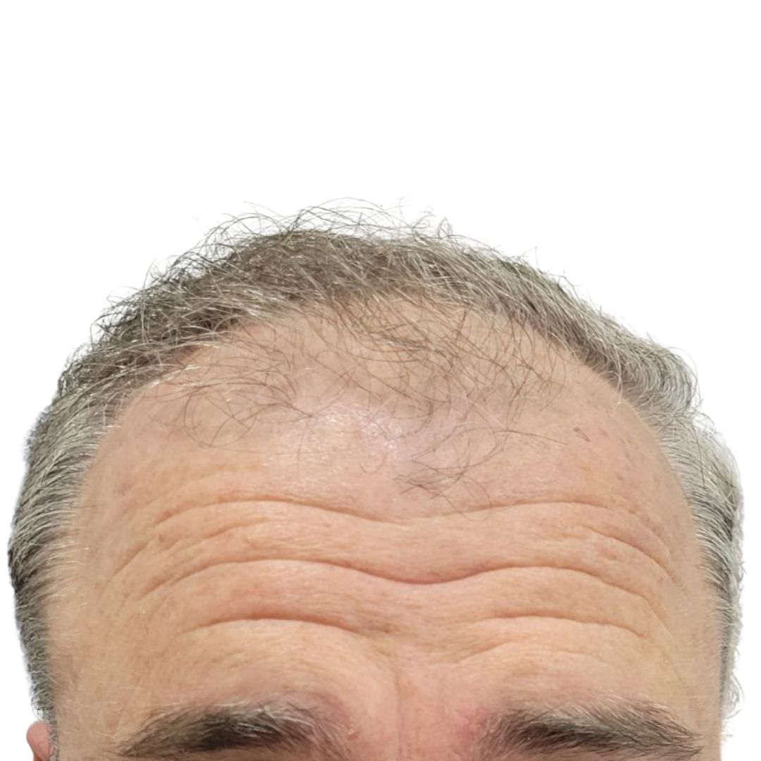 Paciente · línea de implantación frontal — antes