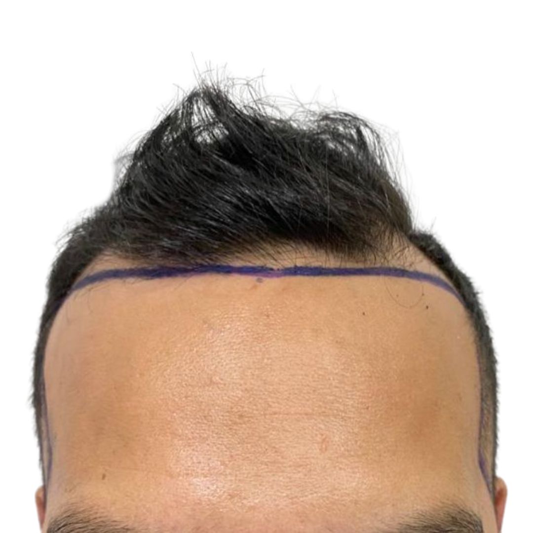 Paciente · entradas y línea frontal — antes