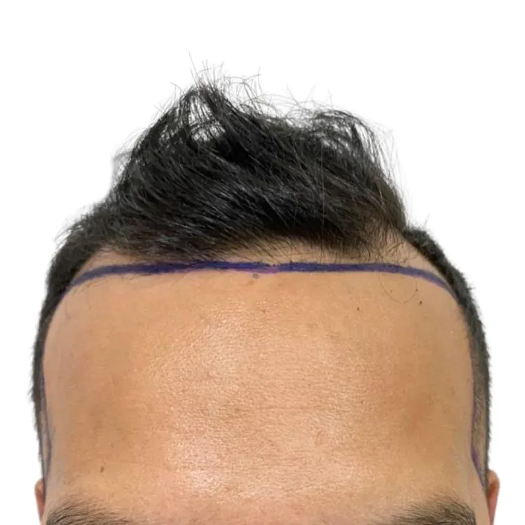 Paciente · entradas y línea frontal — antes