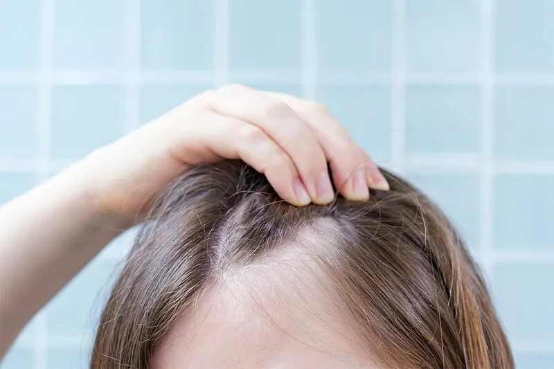 Alopecia femenina