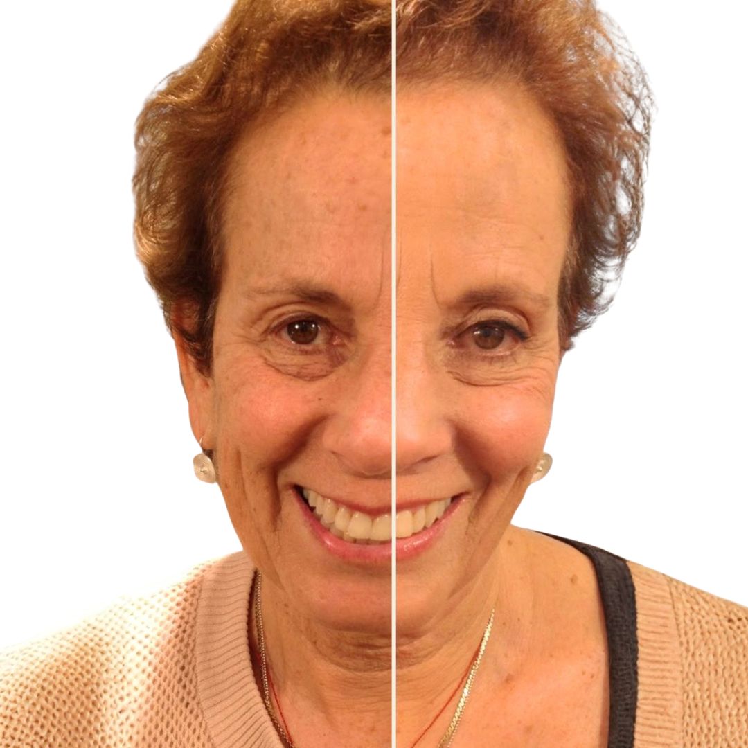 Rejuvenecimiento facial con láser en Zaragoza — Alfa Clinics
