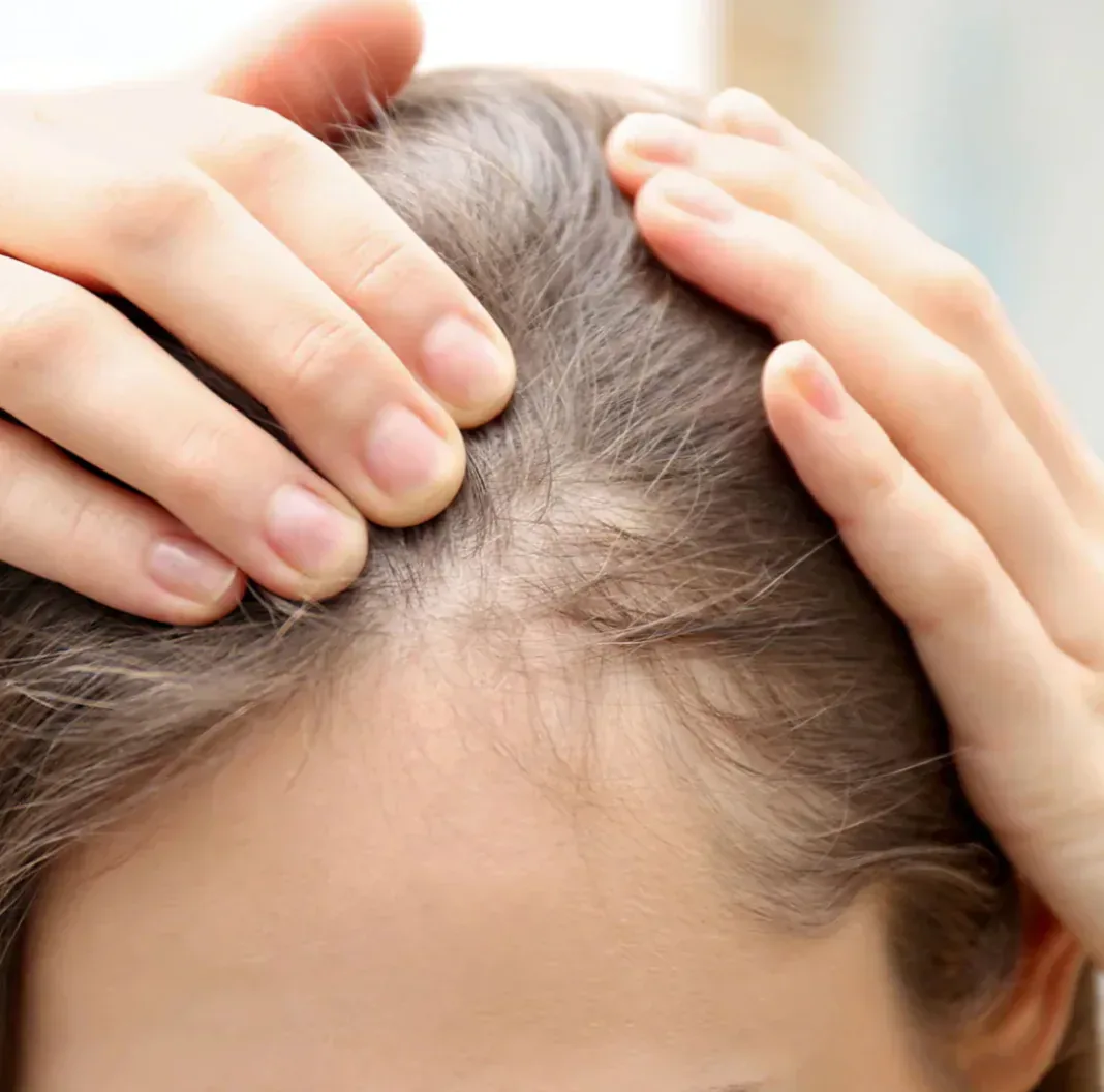 Alopecia femenina y caída del pelo en mujer