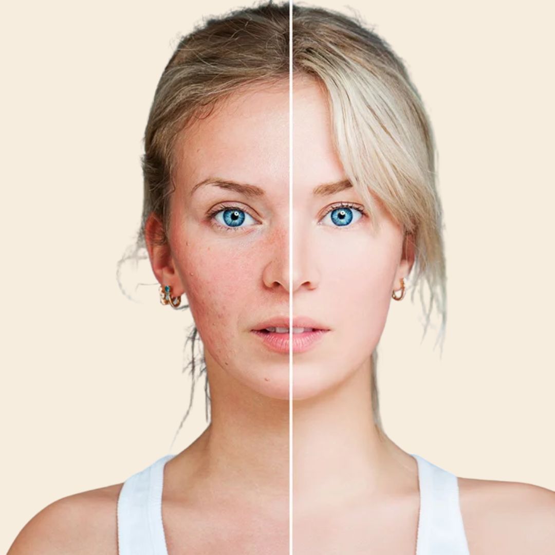 Láser para rosácea y rojeces faciales en Zaragoza — Alfa Clinics