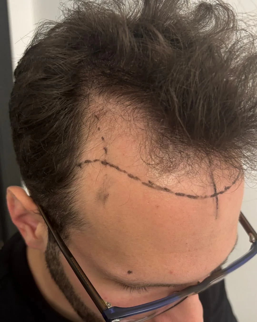 Microinjerto capilar en entradas y línea frontal