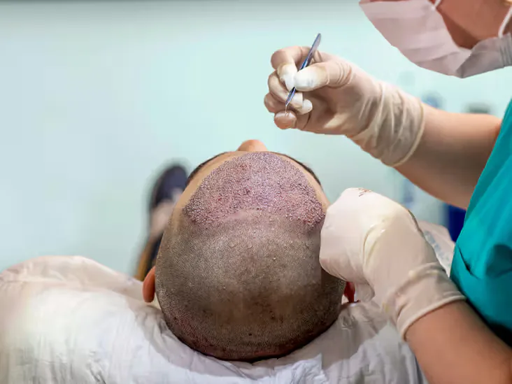 Profesional con guantes y mascarilla utilizando una pinza sobre el cuero cabelludo rasurado de un paciente tumbado durante una intervención capilar