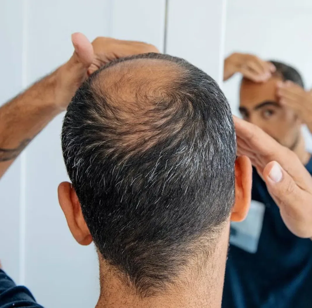 Tratamientos anticaída en Alfa Clinics Zaragoza