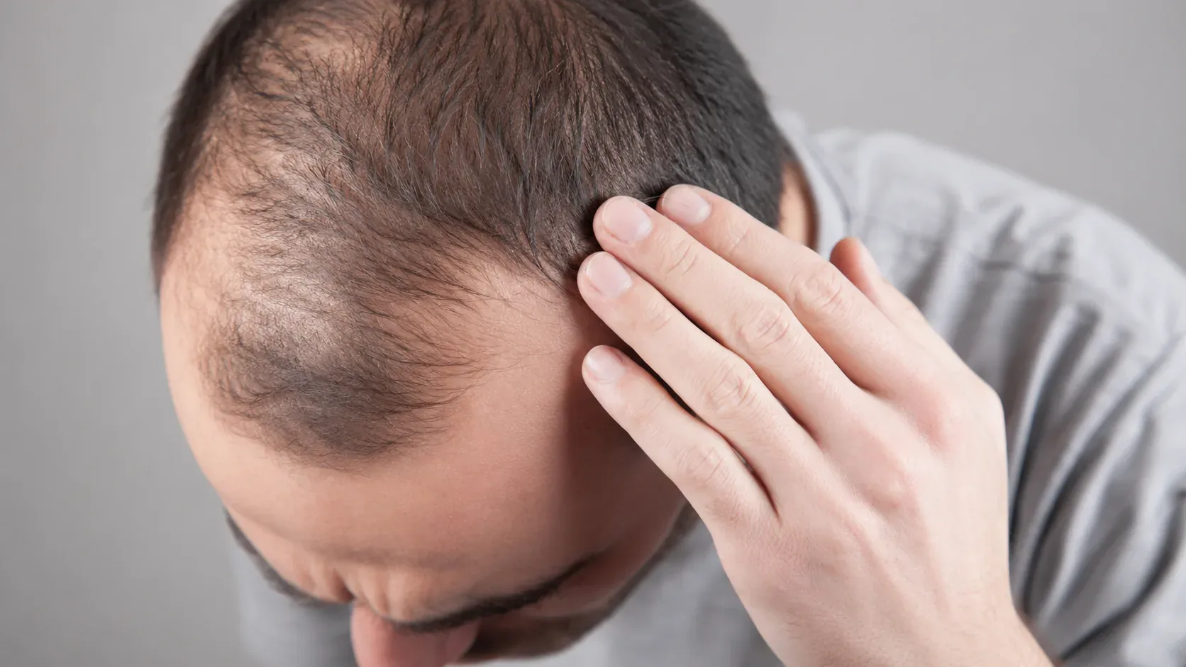Paciente consultando cuánto dura un injerto capilar en Alfa Clinics Zaragoza