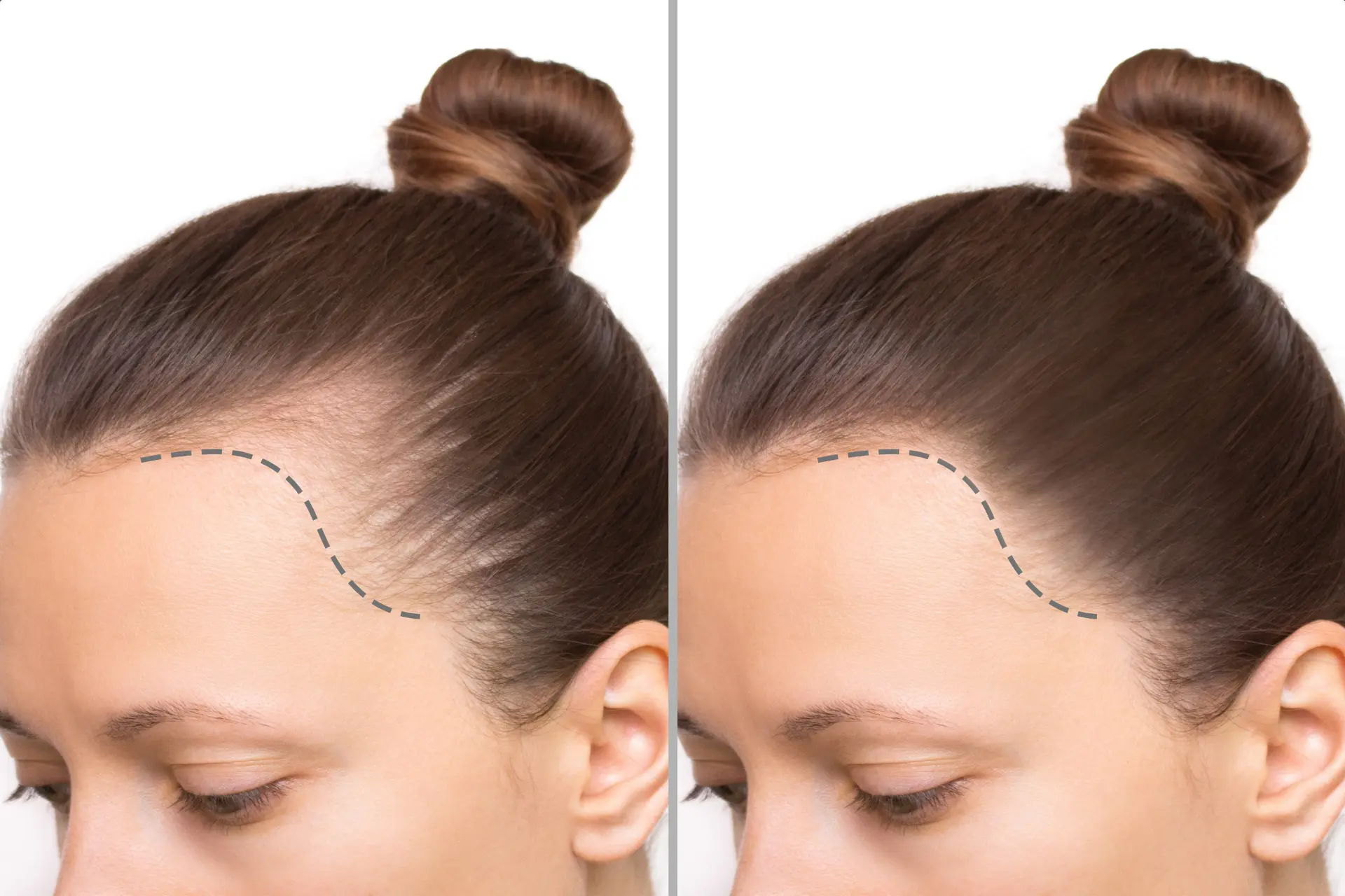 Estudio capilar en mujer con caída del cabello