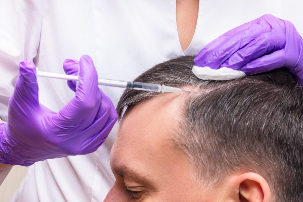 Sesión de PRP capilar para reforzar el cabello