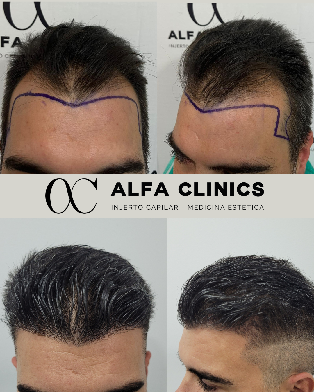 Alfa Clinics ofrece injerto capilar en Zaragoza con precio competitivo, seguimiento profesional y resultado natural