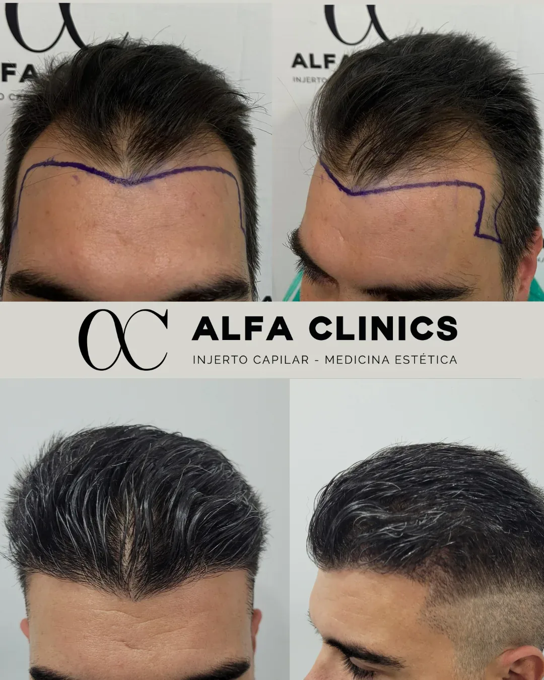 Profesional revisando la zona donante y el diseño capilar de un paciente en consulta